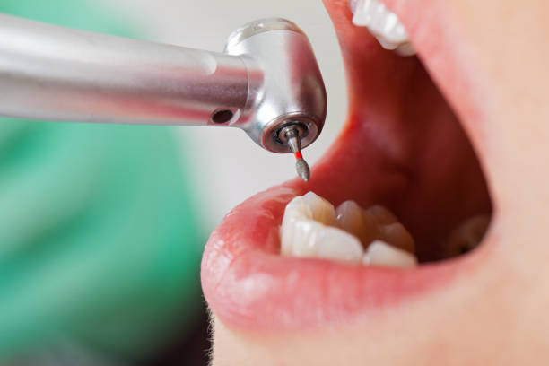 Best Root Canal Emergency Dentist  in Dilworth, MN